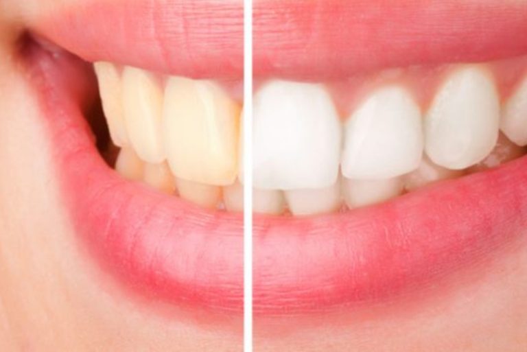 Is Zoom Teeth Whitening Safe